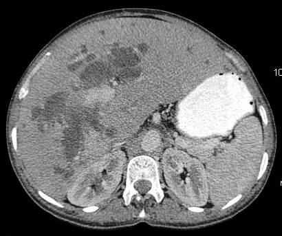 Figure 12: gross hepatomegaly with dilatation of right and left hepatic duct. The confluence is disrupted due to gallbladder neck mass.